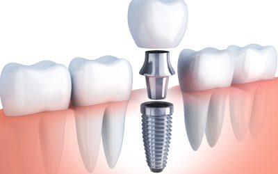Dental implants